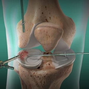 ARTHROSCOPIC SURGERY