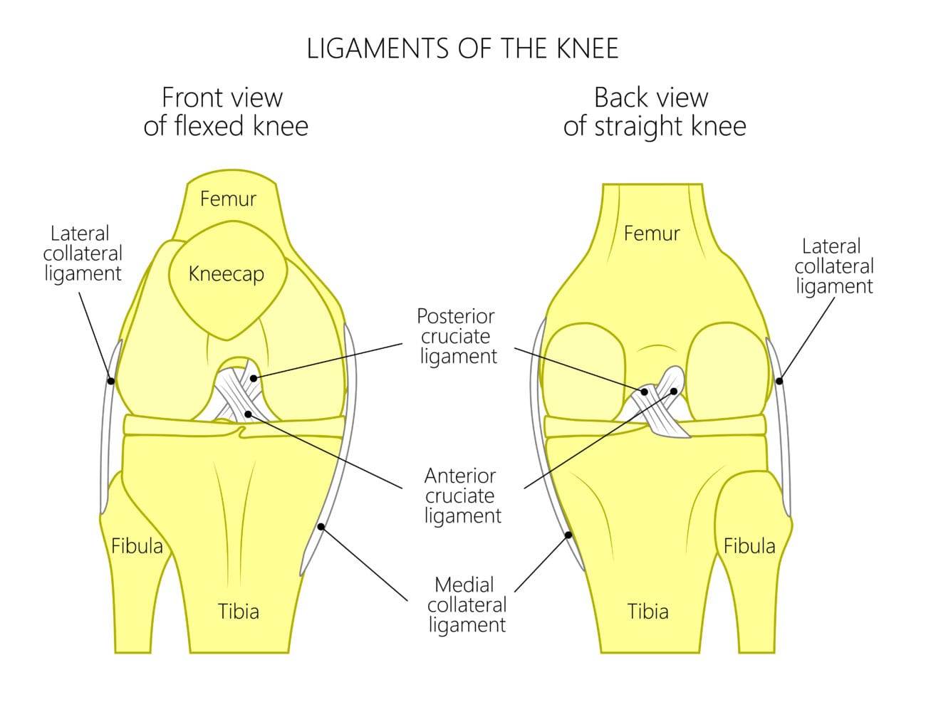 ACL tears diagram