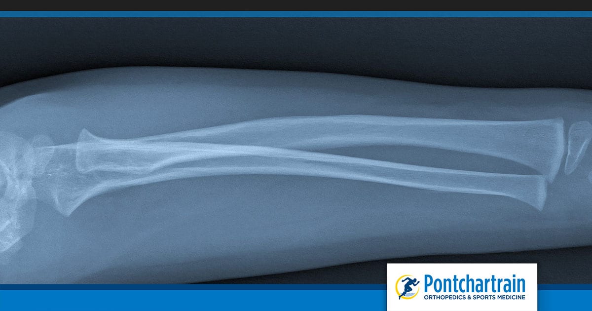 Bone Fractures - Pontchartrain Orthopedics & Sports Medicine