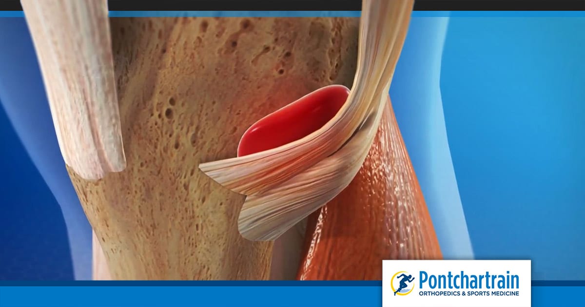 Trochanteric Bursitis: Orthopedic Center for Sports Medicine: Sports  Medicine Physicians