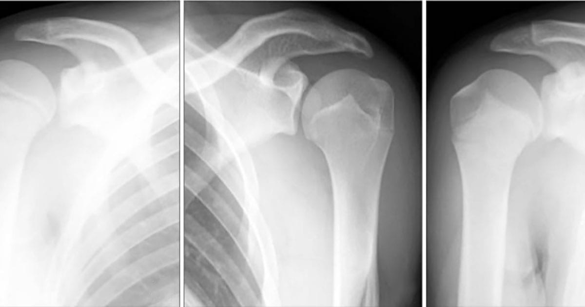 x ray of little league shoulder