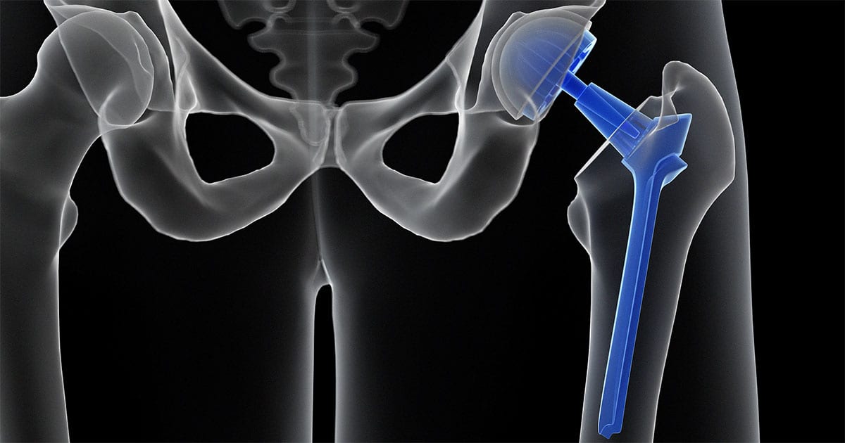 Osteonecrosis Of The Hip