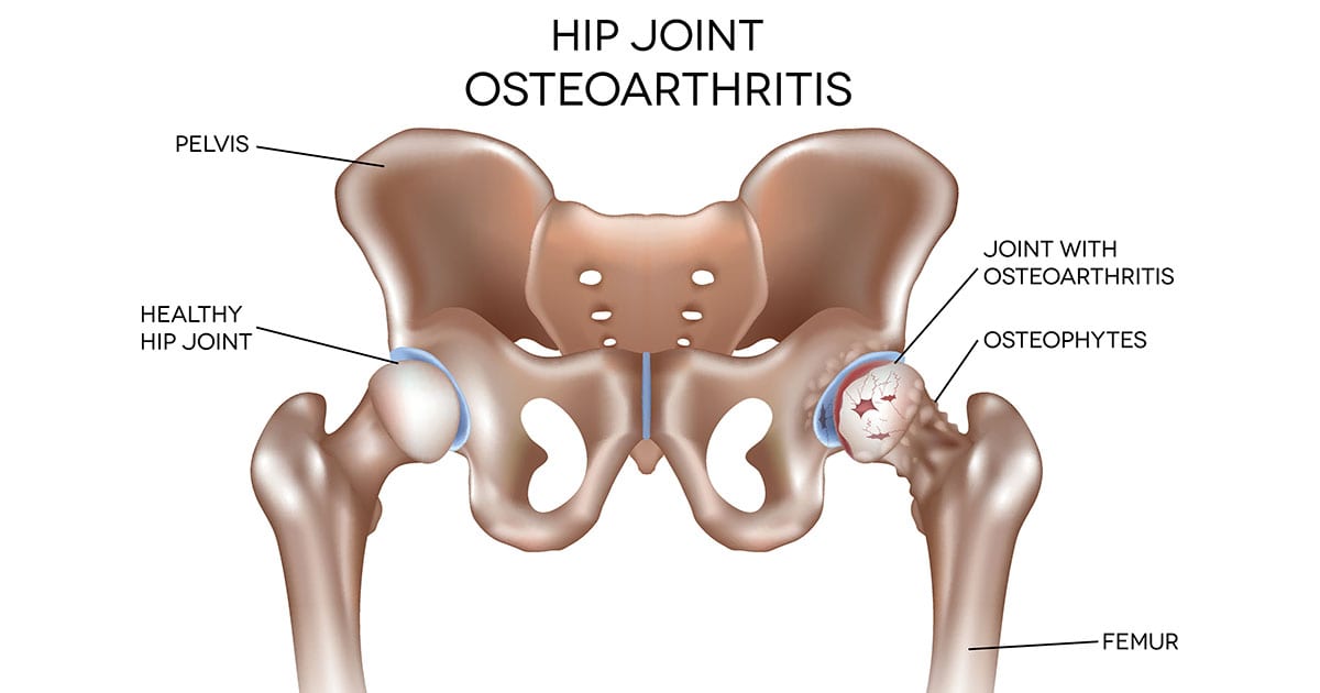 Anatomy of the hip before hip replacement surgery