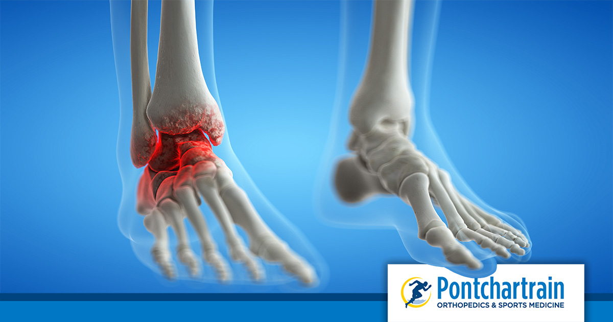 Broken or Sprained Ankle? - Pontchartrain Orthopedics & Sports Med