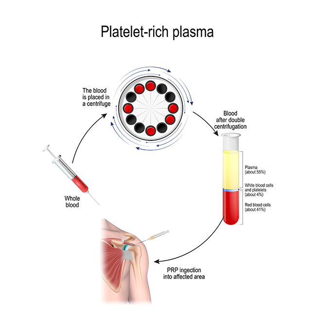 PRP Therapy