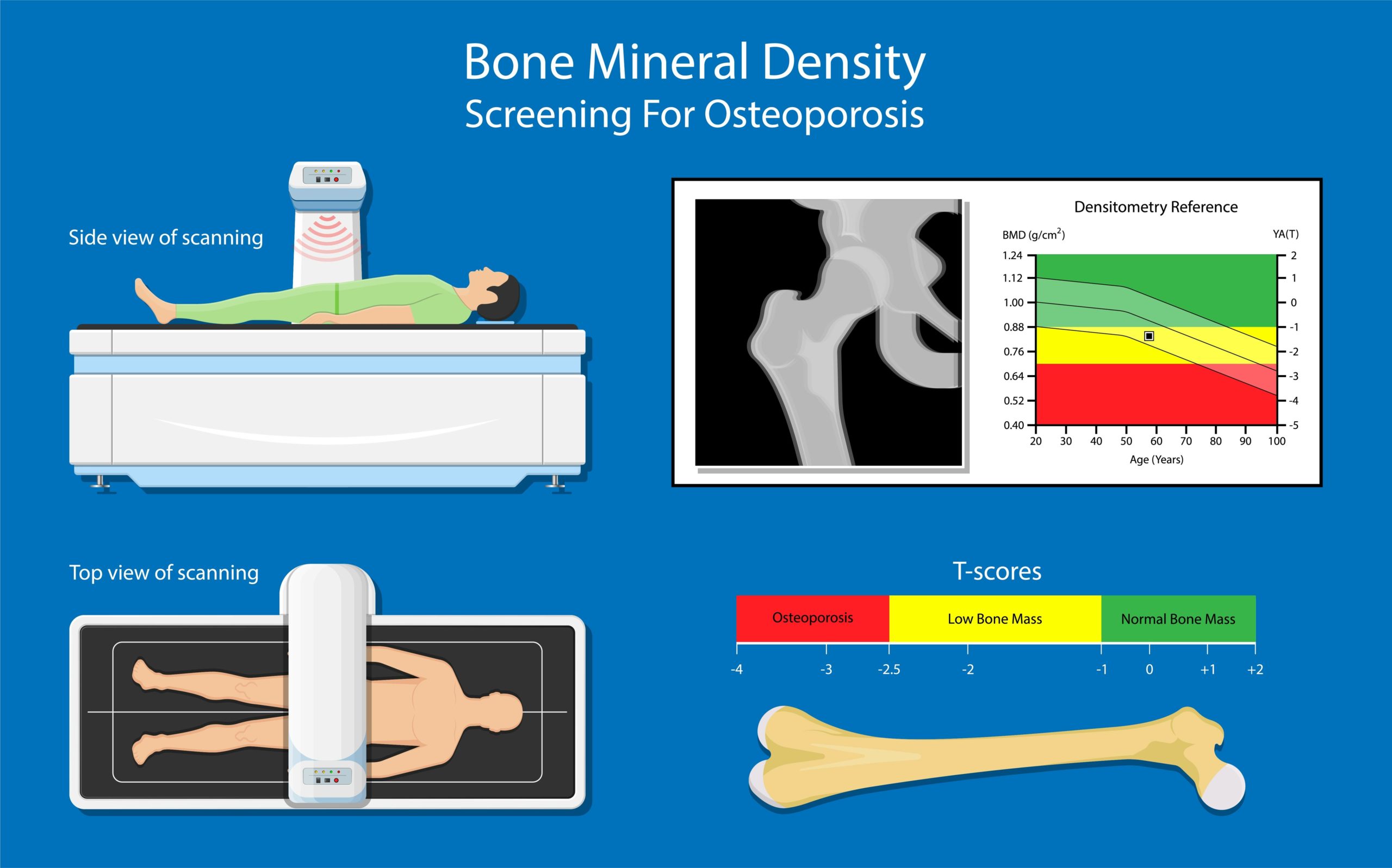 Get screened for osteoporosis using DEXA scans