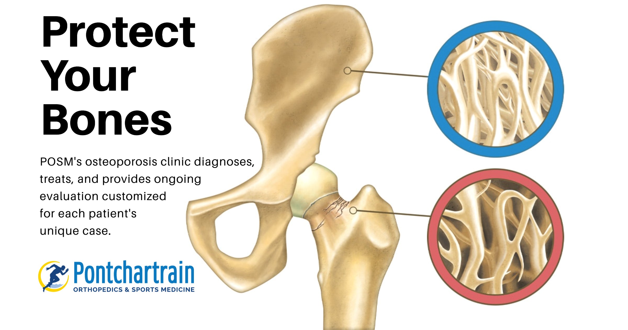 POSM Osteoporosis Clinic - Pontchartrain Orthopedics & Sports Medicine