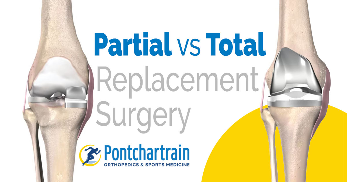 Partial Vs Full Knee Replacement Pontchartrain Orthopedics