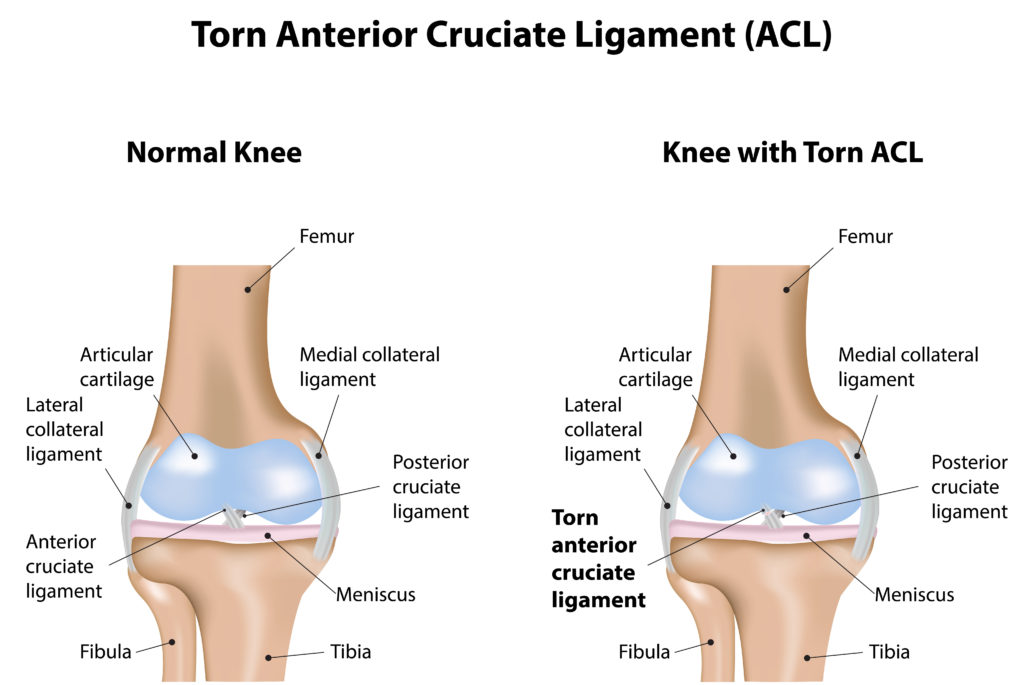 ACL Tear: Symptoms and Treatments for a Torn ACL