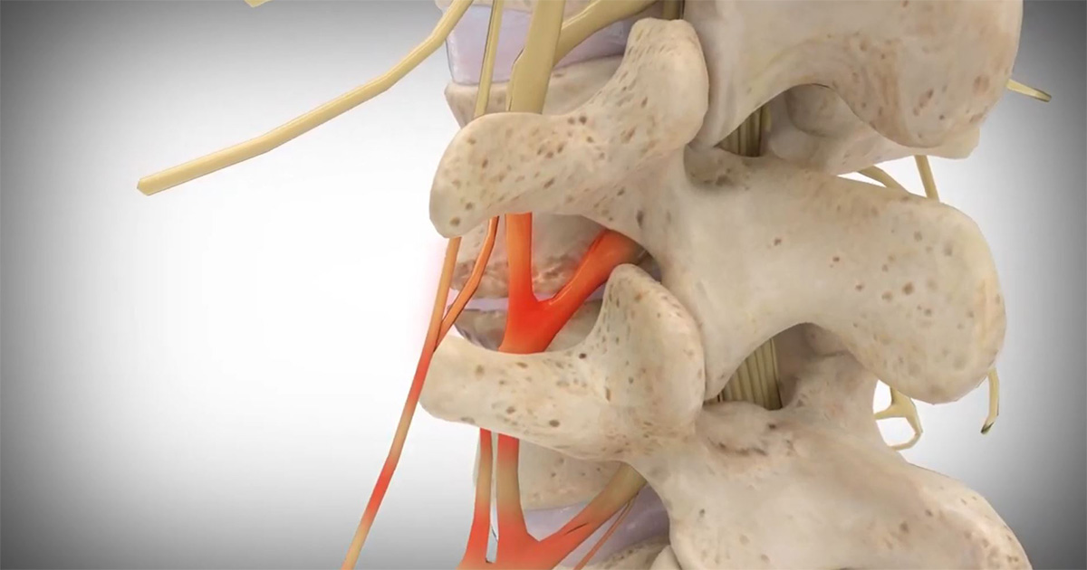 Spinal Stenosis - Pontchartrain Orthopedics & Sports Medicine