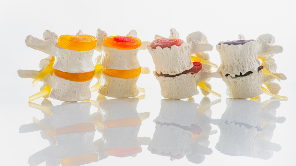 Things to Know About Degenerative Disc Disease - Pontchartrain ...