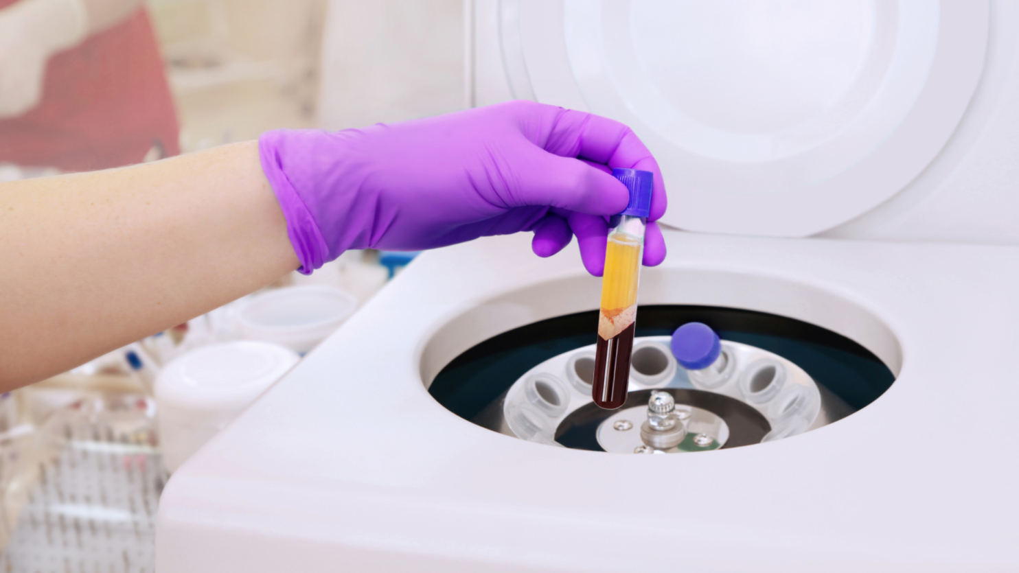 platelet-rich plasma therapy for sports injuries