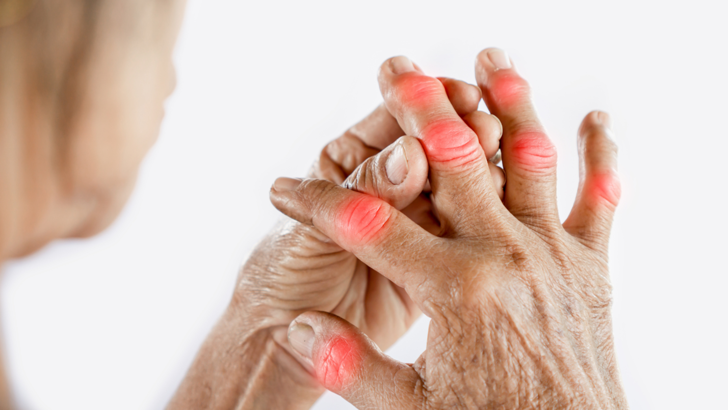 arthritis flare-ups