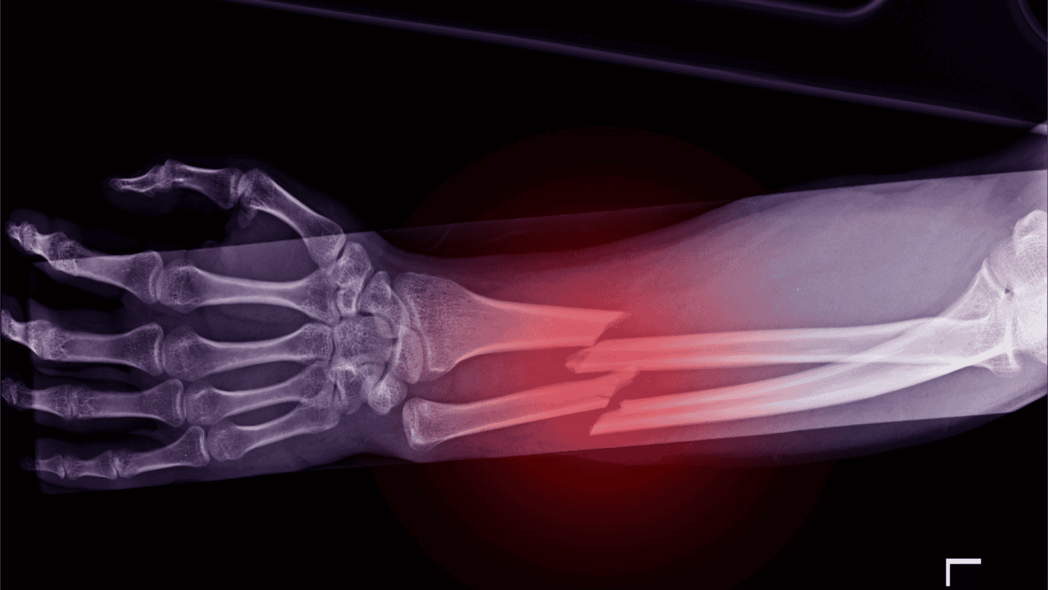 fracture management